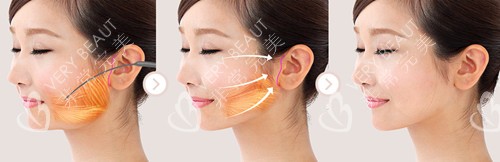 韓國(guó)VG百利酷整形外科拉皮手術(shù)
