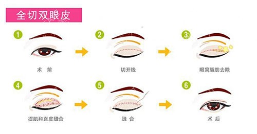 全切双眼皮示意图