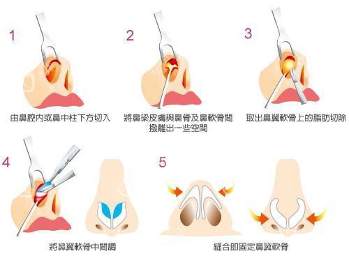 鼻翼缩小示意图