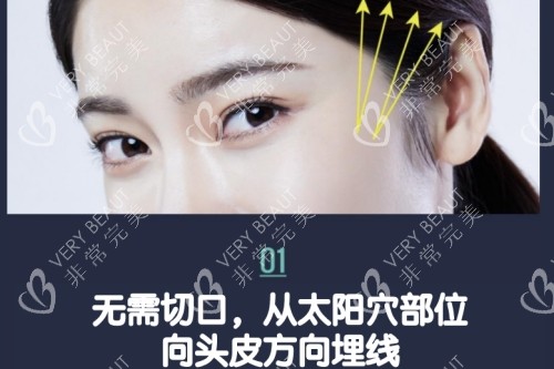 韩国faceplus逆向埋线提升术示意图
