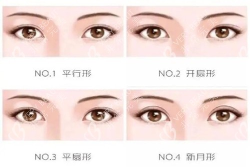 雙眼皮的四種類型