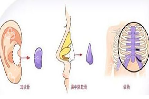 隆鼻不同位置材料示意图