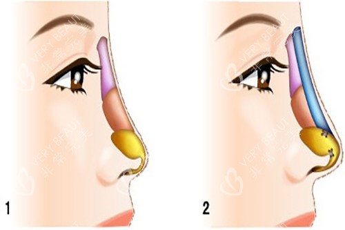 不同方式隆鼻对比