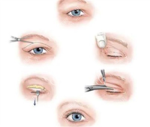 双眼皮全切手术方法的图片