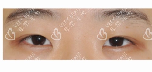 韓國4月31日整形外科眼型矯正前