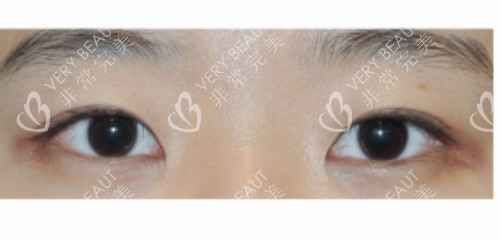 韓國4月31日整形外科眼型矯正后