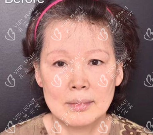 韩国VG百利酷整形外科拉皮前