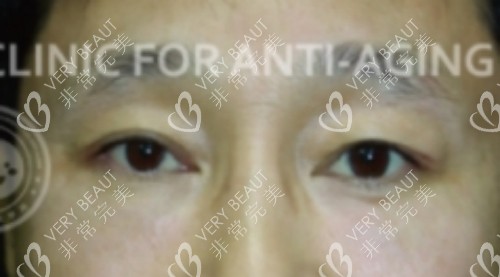 韩国JF皮肤科眼底脂肪填充2