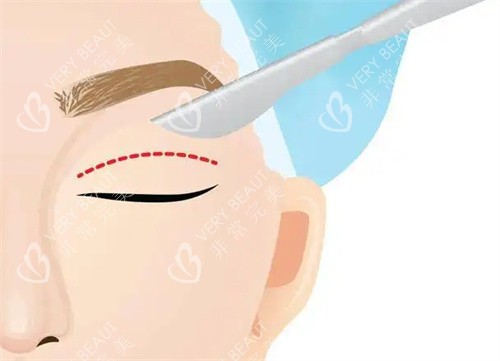 双眼皮手术动漫展示图