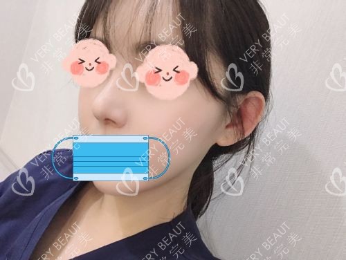 韩国VG百利酷整形医院手术方案设计后