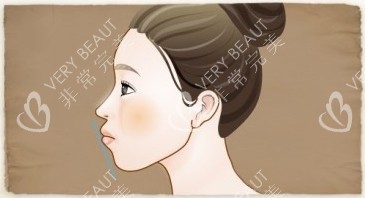 凸嘴漫畫(huà)示意圖