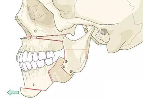 下颏截骨成形术改善下巴后缩示意图