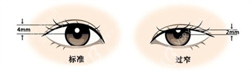 标准双眼皮与过窄双眼皮展示图