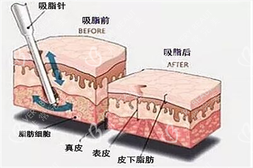 吸脂时皮肤各层次解剖示意图