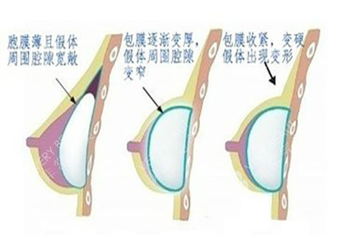 隆胸假体出现包膜挛缩的变化过程图