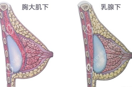 隆胸假体的不同放置位置解剖图