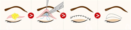 双眼皮手术动画模拟展示图