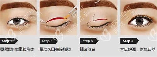 双眼皮手术流程细节展示图