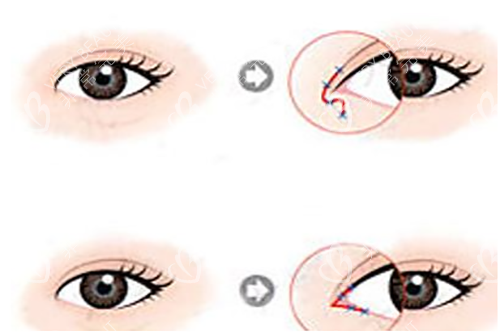 轻度内眦赘皮配合开眼角手术过程示意图