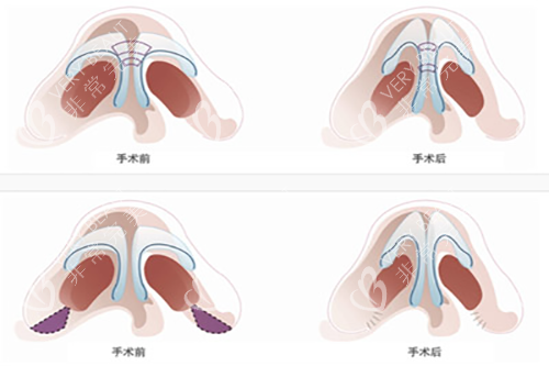 鼻综合整形解剖示意图