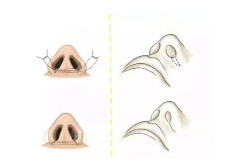 内切法和外切法缩小鼻翼对比示意图