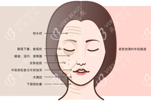 面部埋線提升前后對(duì)比