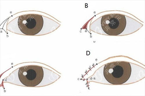 有内眦赘皮的开眼角手术示意图