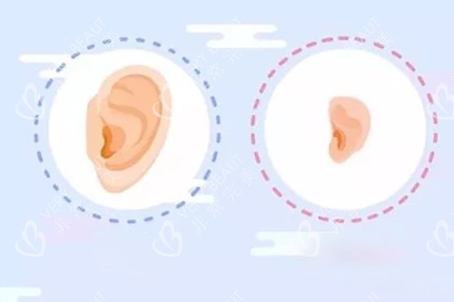 正常耳廓形态和小耳畸形对比示意图