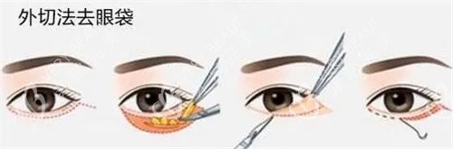 外切法祛眼袋流程展示图