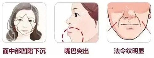 鼻基底凹陷引起的面部症状图示