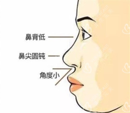 鼻基底凹陷导致的面部问题分析图