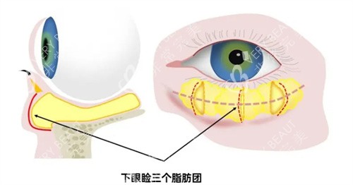 眶隔脂肪在哪里图片