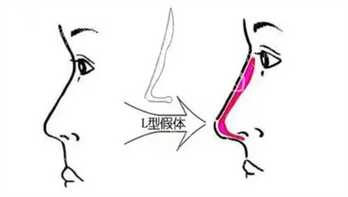L型假体隆鼻成效图
