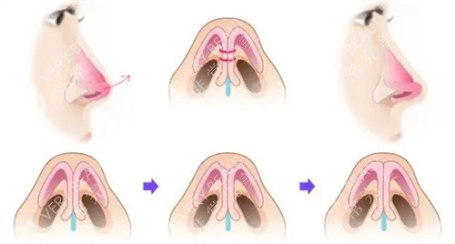 鼻整形过程前后对比展示图