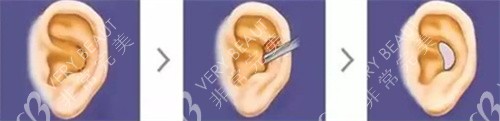耳软骨取出流程动画图