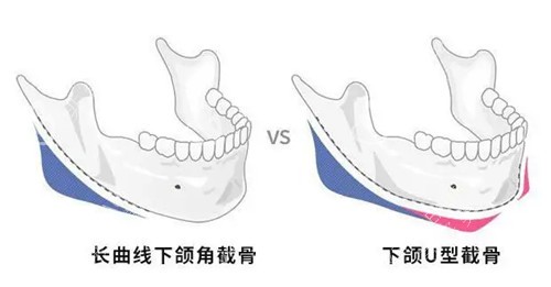不同下颌角截骨方式对比