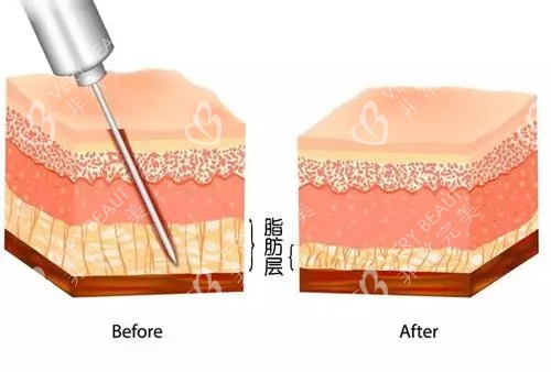 吸脂前后脂肪层对比示意图