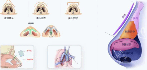鼻子整形手術(shù)步驟動畫圖
