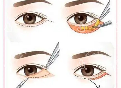 外切法去除眼袋过程示意图