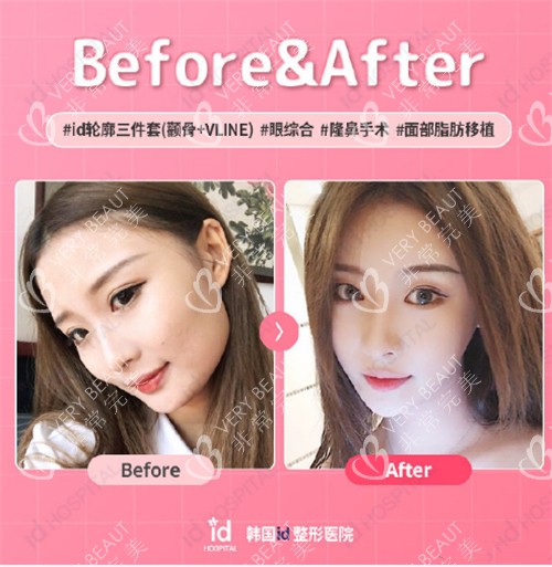 韓國(guó)id醫(yī)院輪廓三件套真人例子