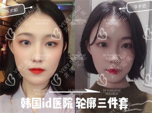 韓國(guó)id醫(yī)院輪廓三件套前后圖