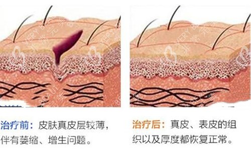 皮肤疤痕微观示意图