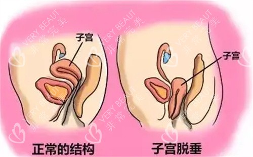 正常子宫与子宫脱垂对比图