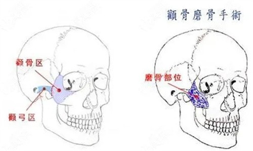 颧骨磨骨手术操作说明图