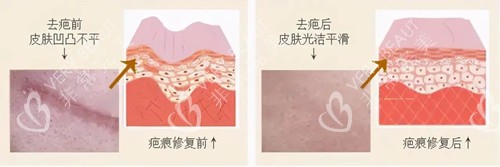 祛除疤痕前后对比示意图