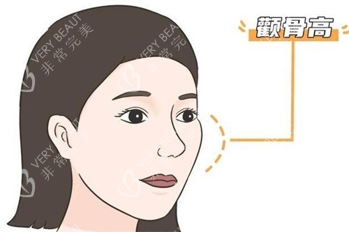 高颧骨侧面展示图