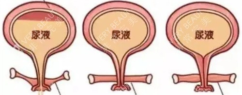 膀胱储存尿液动画说明图