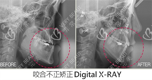   韓國faceline齙牙矯正示意圖