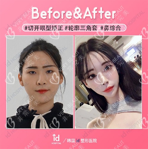 韓國ID醫(yī)院輪廓三件套前后圖