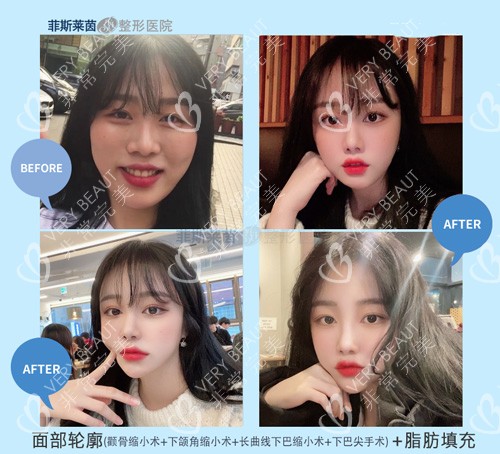韓國菲斯萊茵輪廓三件套對比照